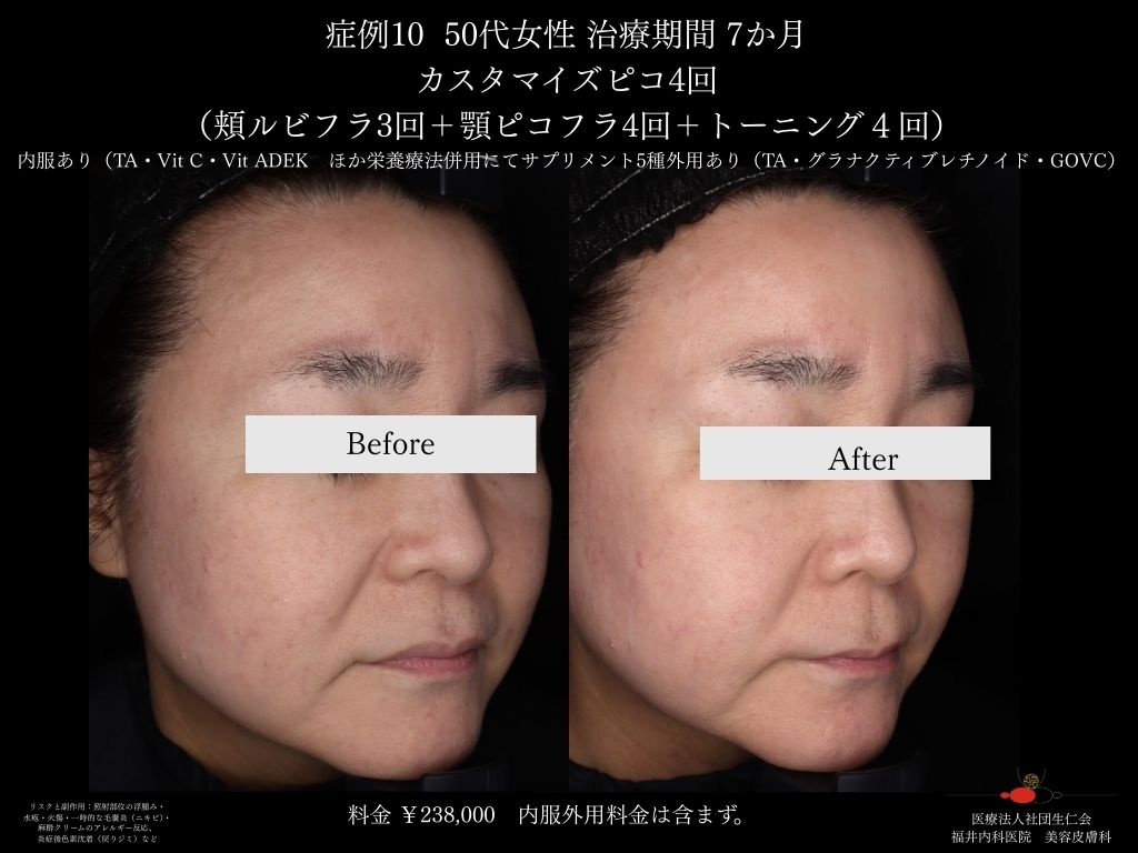 ピコレーザー症例_vol.10_002