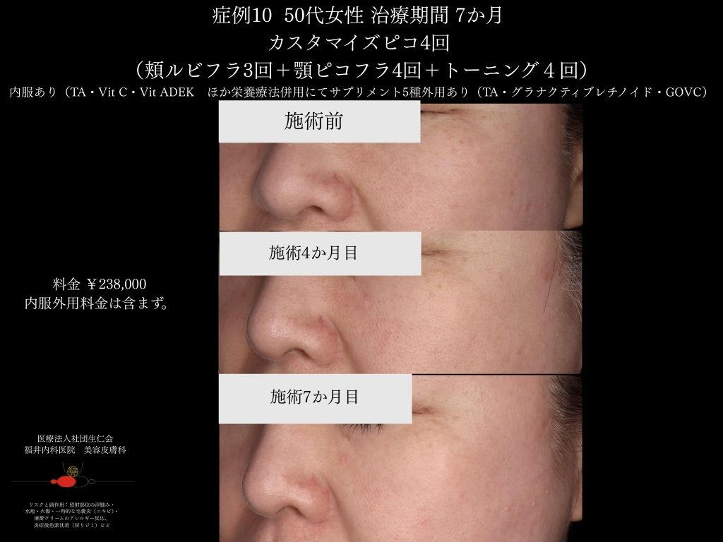 ピコレーザー症例_vol.10_003