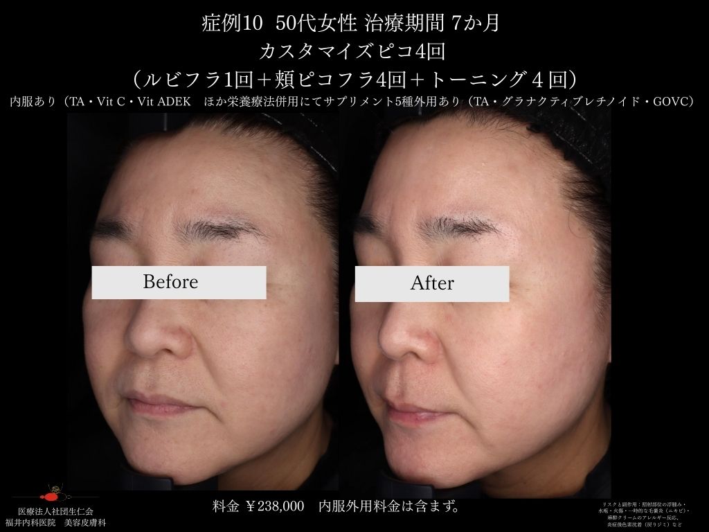 ピコレーザー症例_vol.10_004