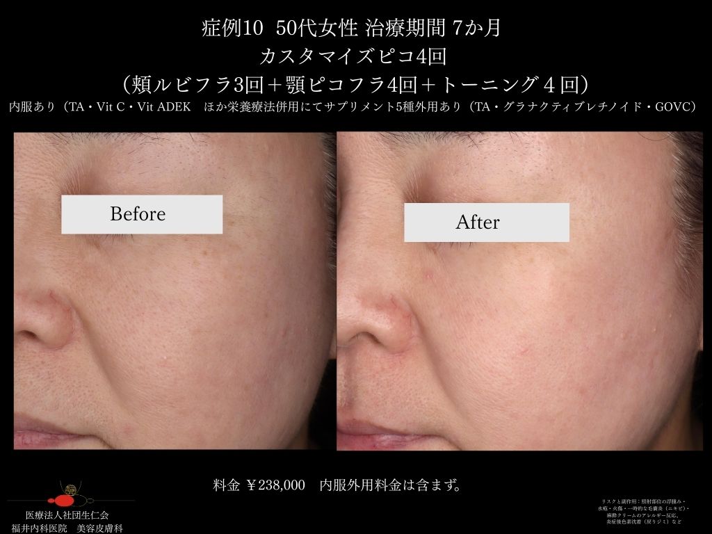 ピコレーザー症例_vol.10_005