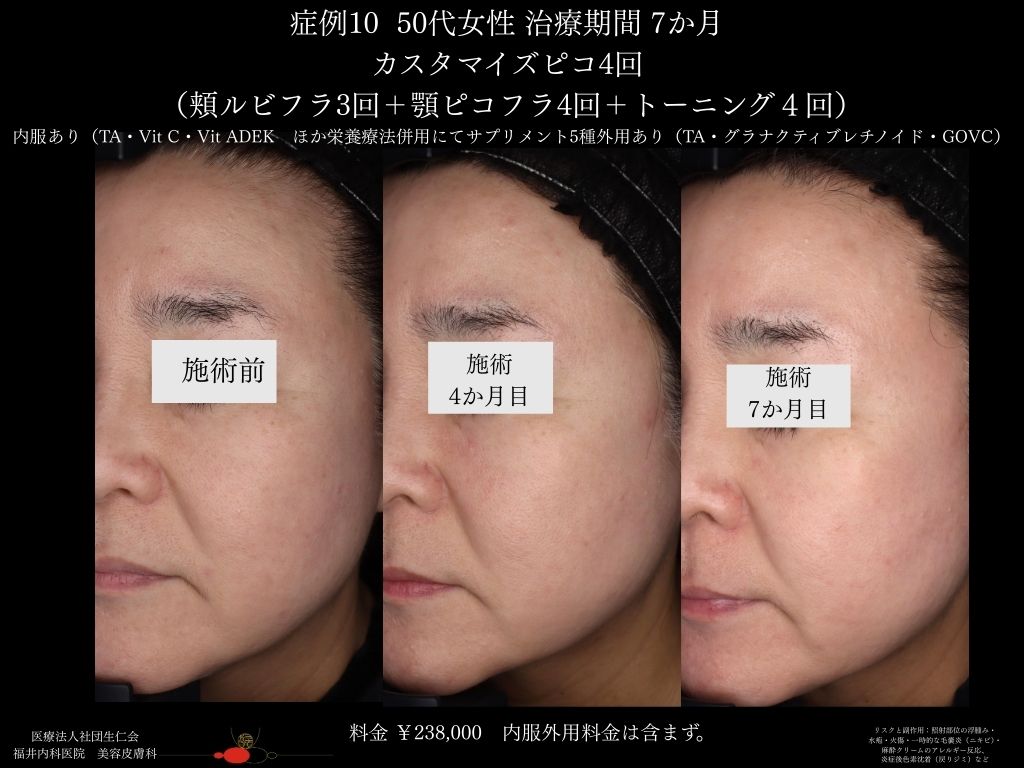 ピコレーザー症例_vol.10_006