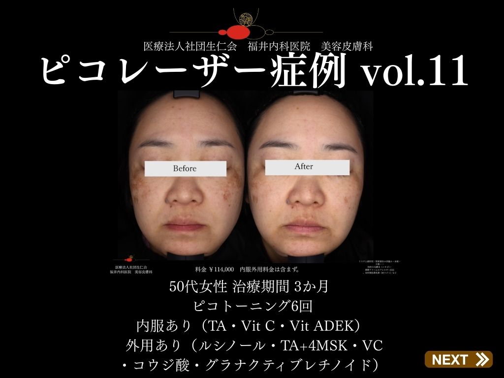 ピコレーザー症例_vol.11_001