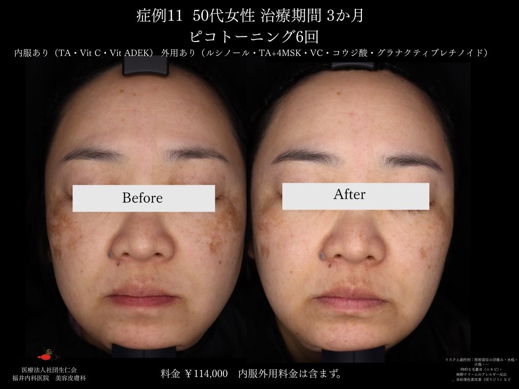 ピコレーザー症例_vol.11_002