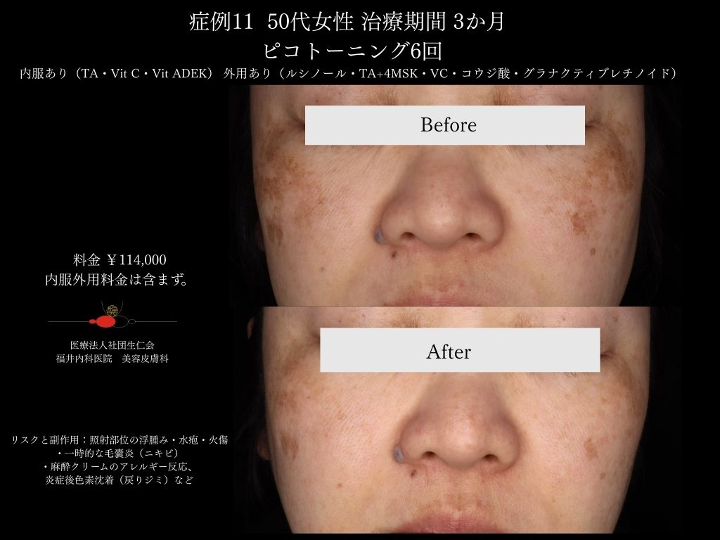 ピコレーザー症例_vol.11_003