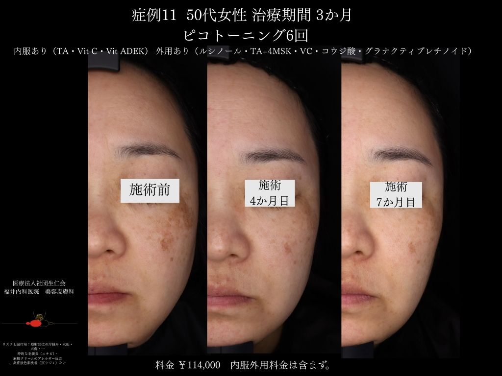 ピコレーザー症例_vol.11_004
