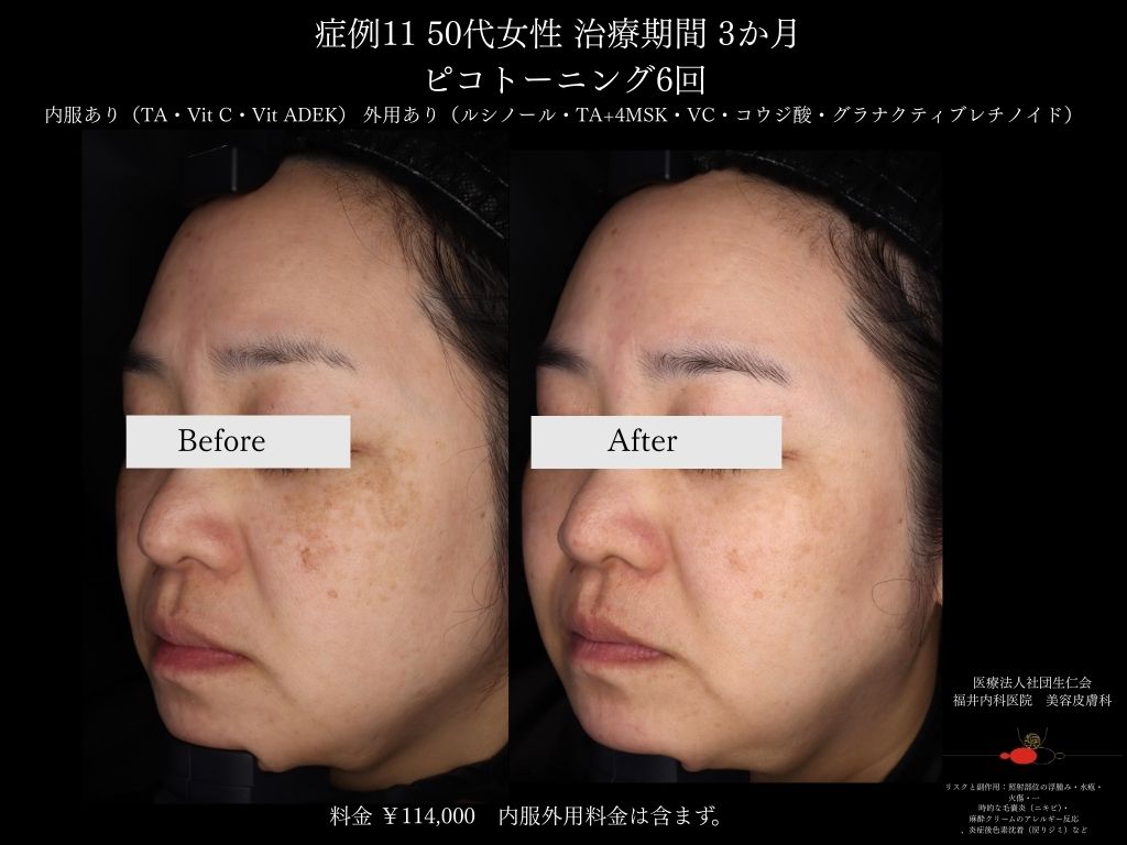 ピコレーザー症例_vol.11_005