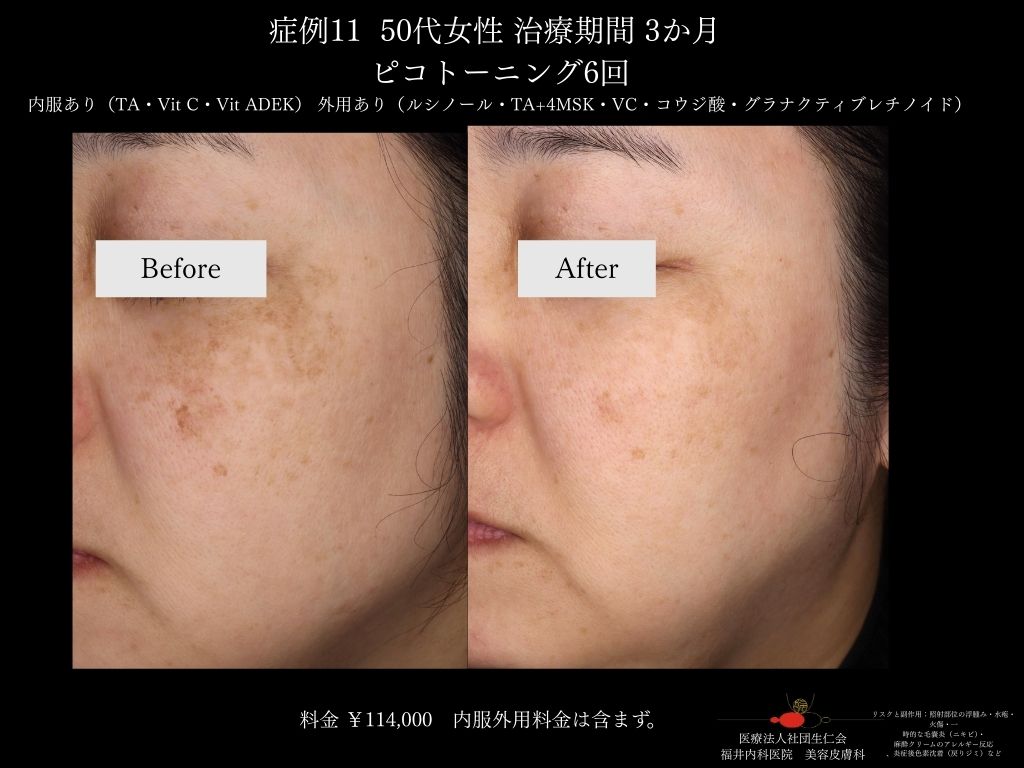 ピコレーザー症例_vol.11_006