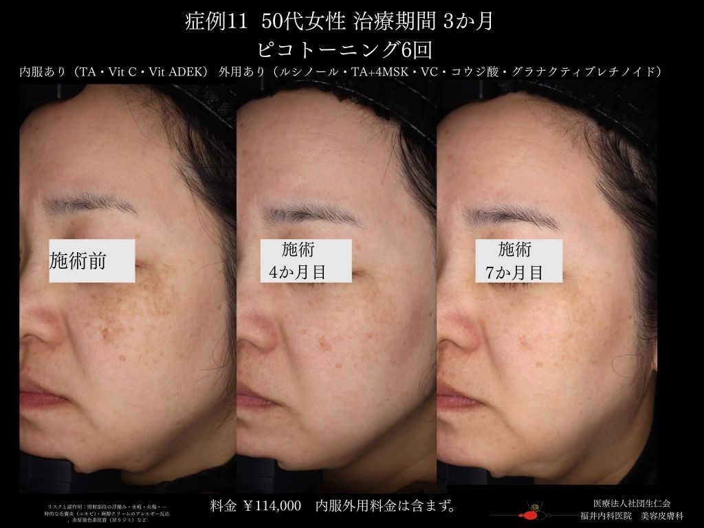 ピコレーザー症例_vol.11_007