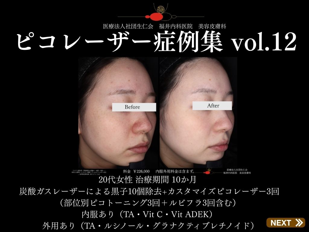 ピコレーザー症例_vol.12_001