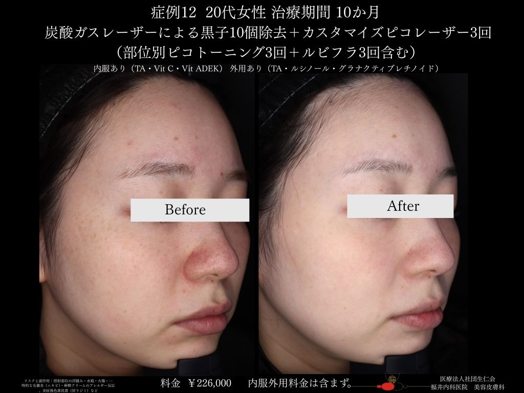 ピコレーザー症例_vol.12_002