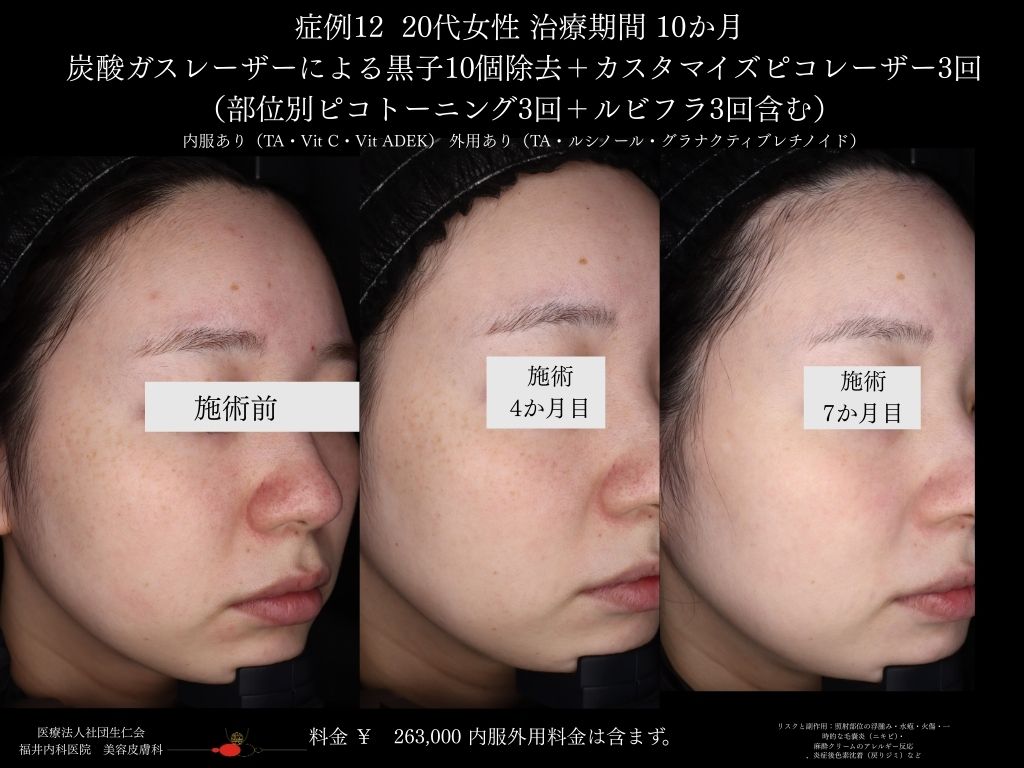 ピコレーザー症例_vol.12_003