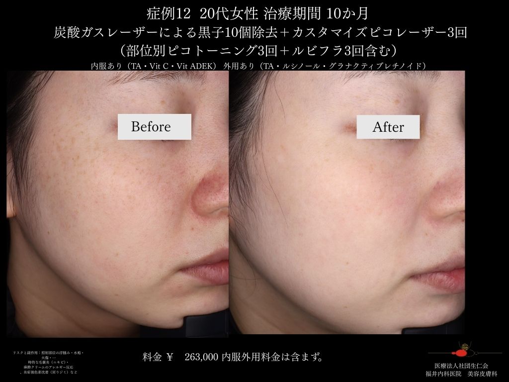 ピコレーザー症例_vol.12_004