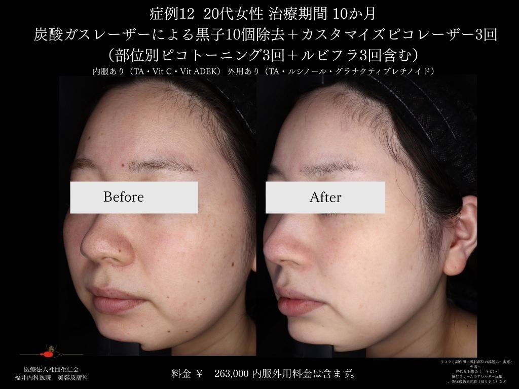 ピコレーザー症例_vol.12_005