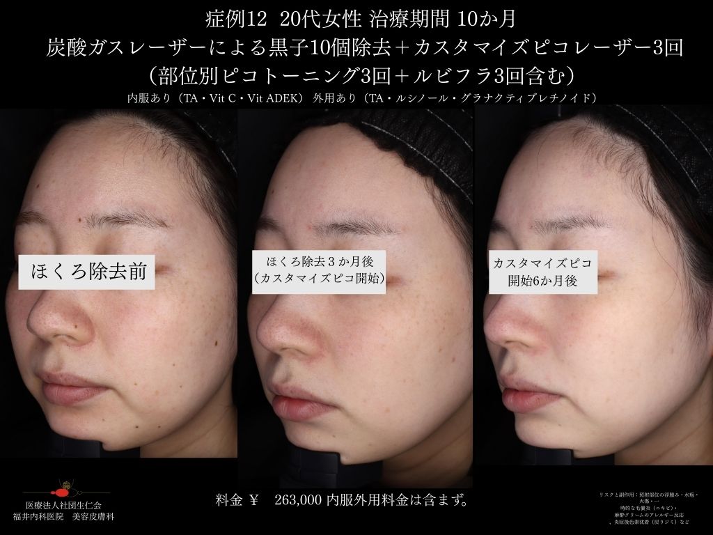 ピコレーザー症例_vol.12_006