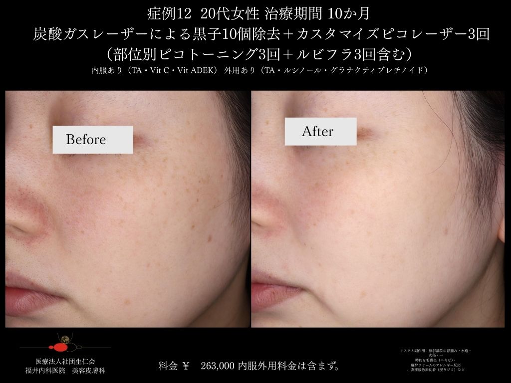 ピコレーザー症例_vol.12_007