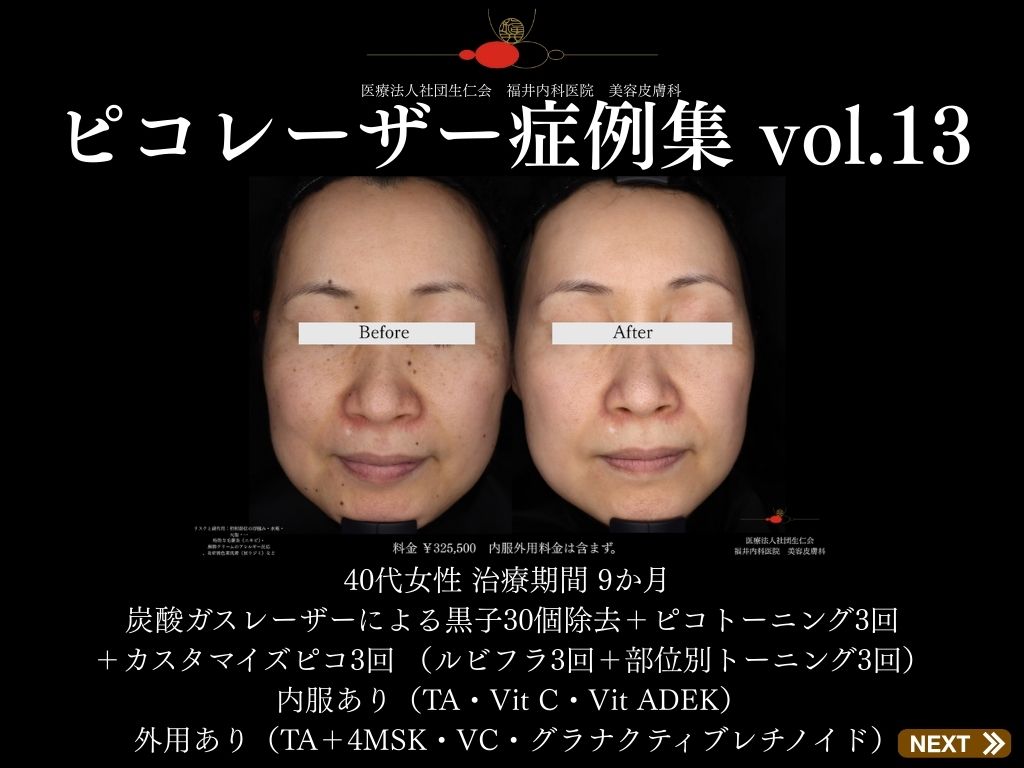 ピコレーザー症例_vol.13_001