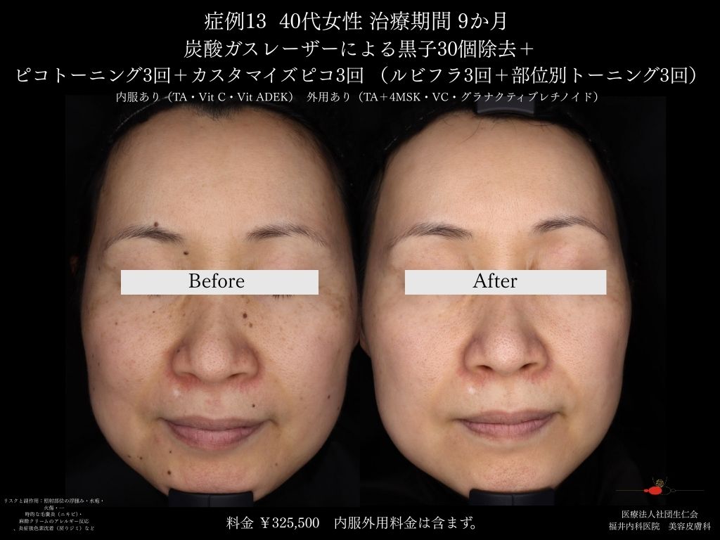 ピコレーザー症例_vol.13_002