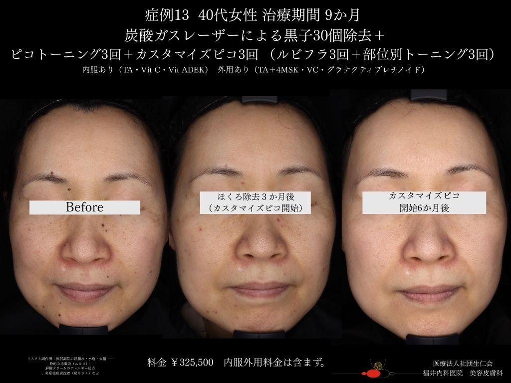 ピコレーザー症例_vol.13_003