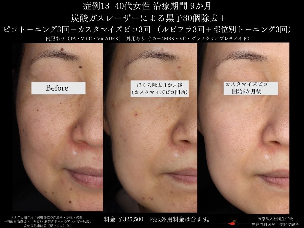 ピコレーザー症例_vol.13_004