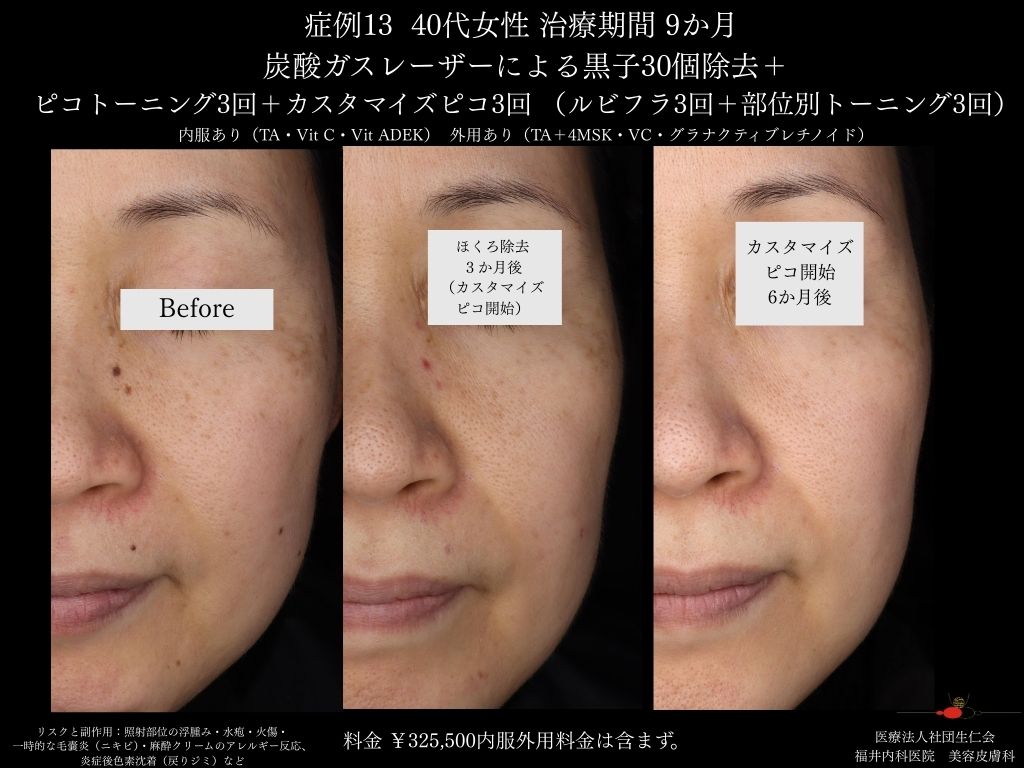 ピコレーザー症例_vol.13_005