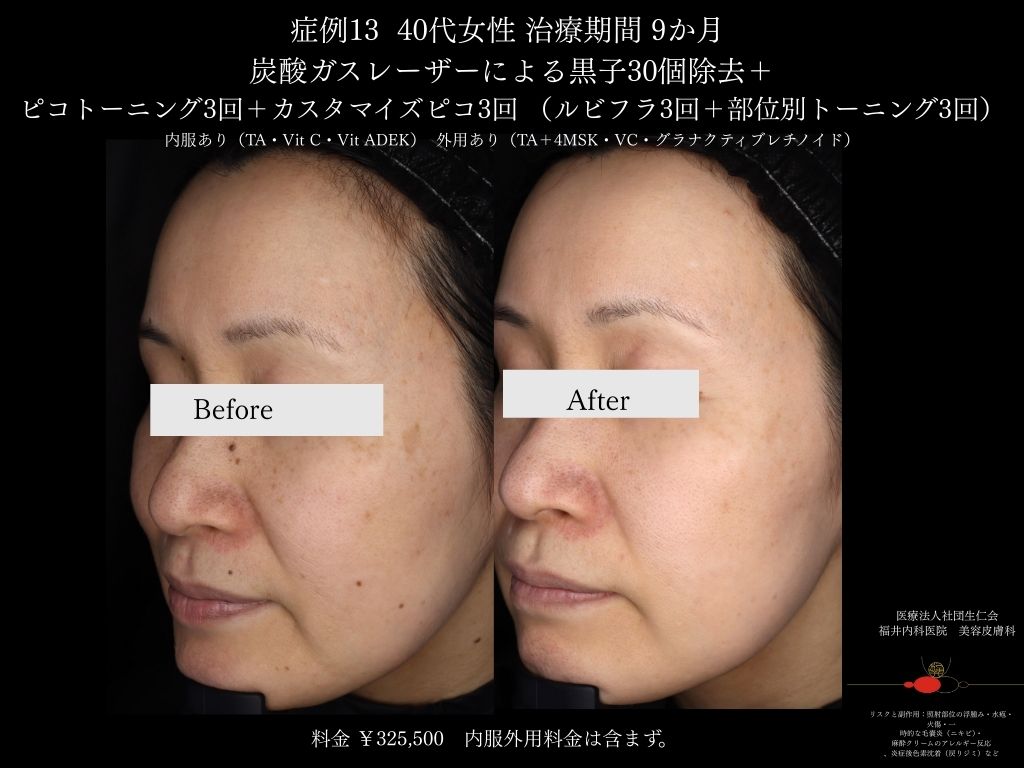 ピコレーザー症例_vol.13_006