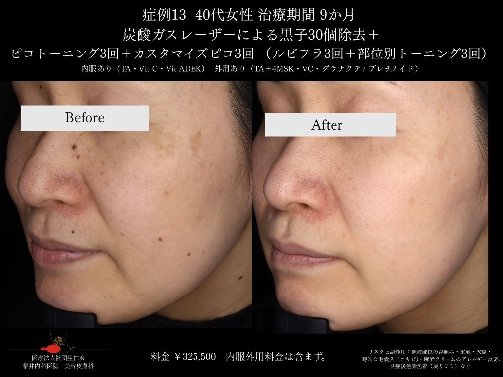 ピコレーザー症例_vol.13_007