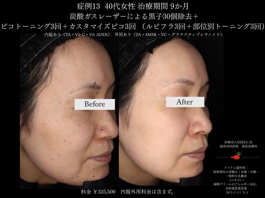 ピコレーザー症例_vol.13_008