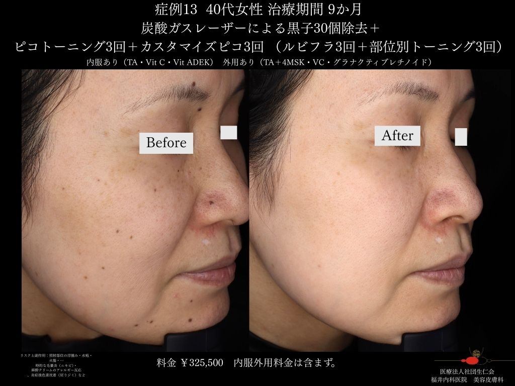 ピコレーザー症例_vol.13_009