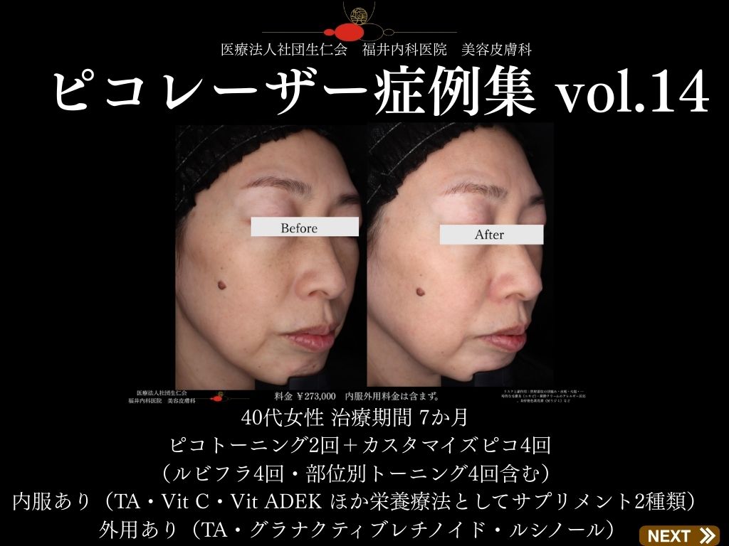 ピコレーザー症例_vol.14_001