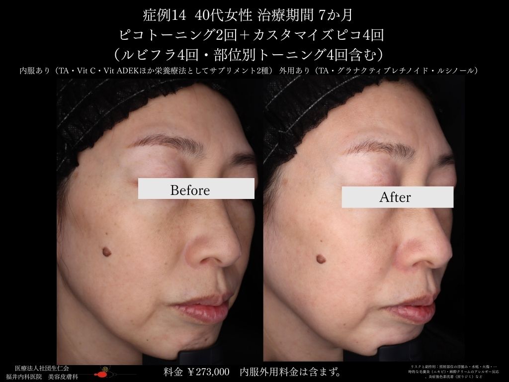 ピコレーザー症例_vol.14_002