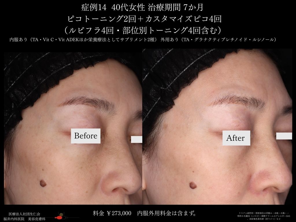 ピコレーザー症例_vol.14_003