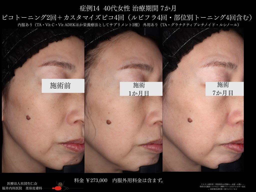 ピコレーザー症例_vol.14_004