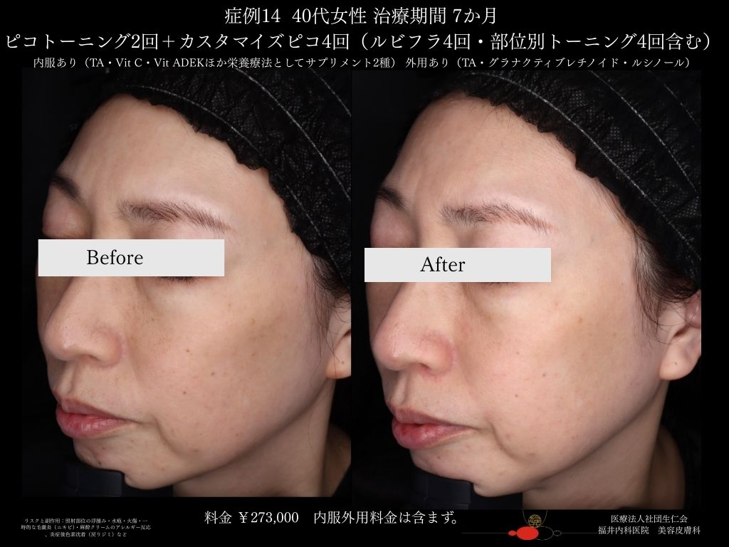 ピコレーザー症例_vol.14_005