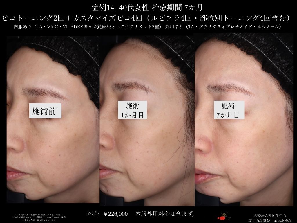 ピコレーザー症例_vol.14_006