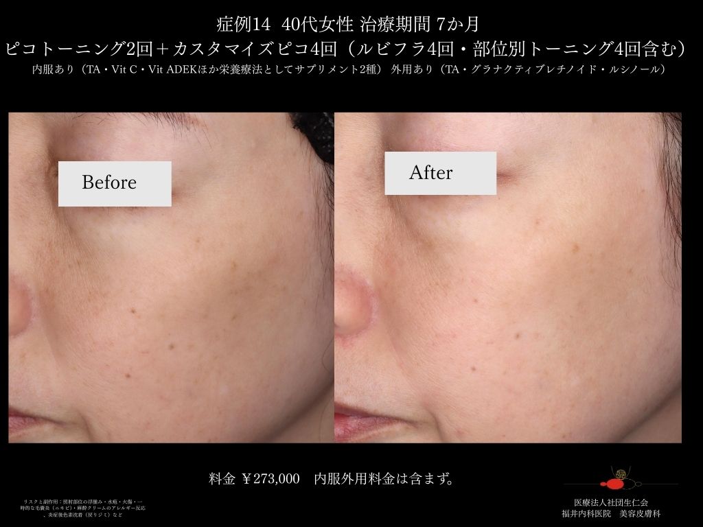 ピコレーザー症例_vol.14_007