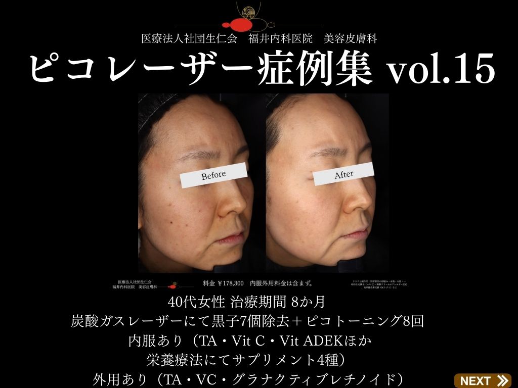 ピコレーザー症例_vol.15_001