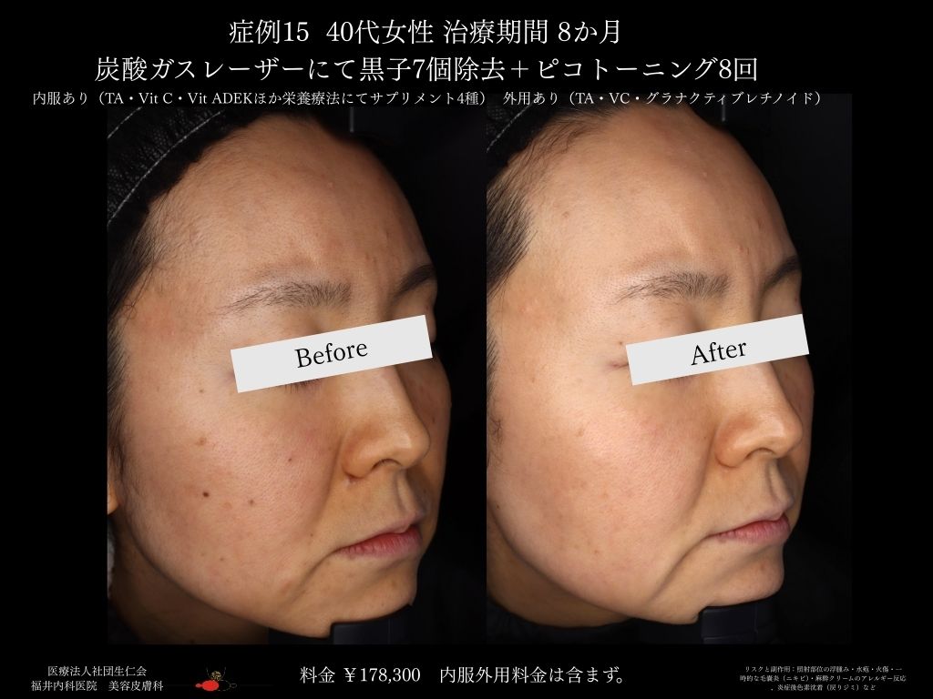 ピコレーザー症例_vol.15_002