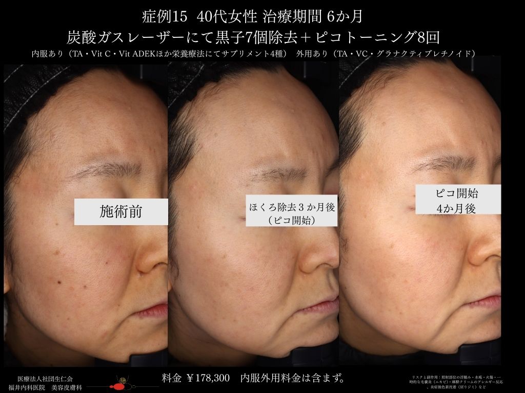 ピコレーザー症例_vol.15_003