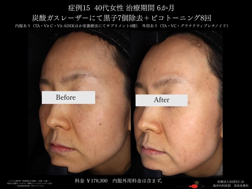 ピコレーザー症例_vol.15_004