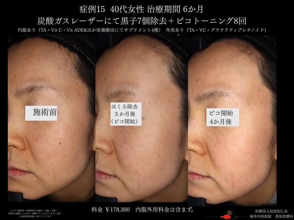 ピコレーザー症例_vol.15_005