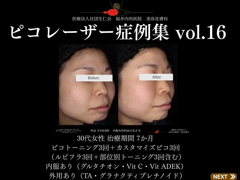 ピコレーザー症例_vol.16_001