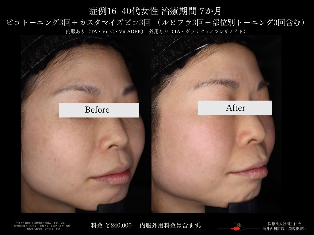 ピコレーザー症例_vol.16_002