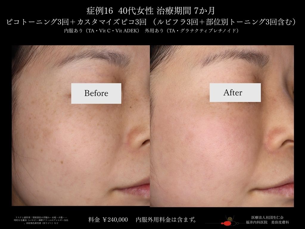 ピコレーザー症例_vol.16_003