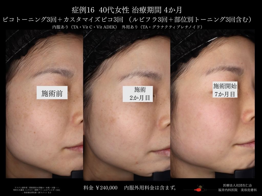 ピコレーザー症例_vol.16_004