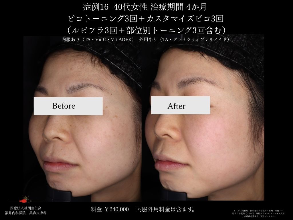 ピコレーザー症例_vol.16_005