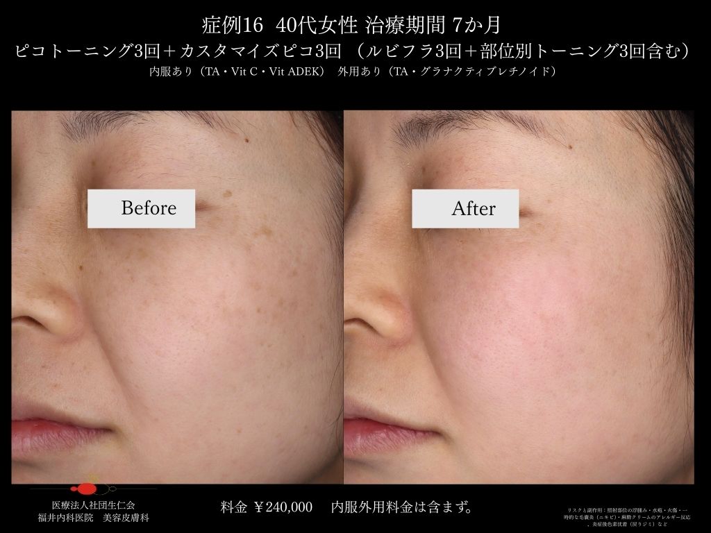 ピコレーザー症例_vol.16_006