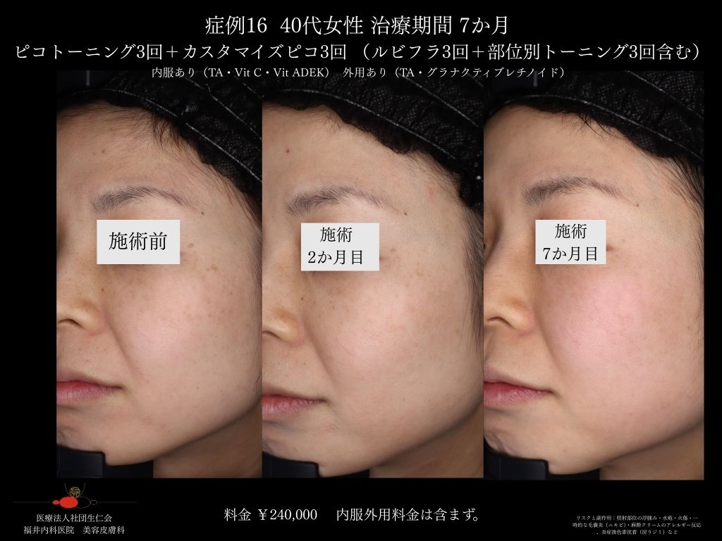 ピコレーザー症例_vol.16_007