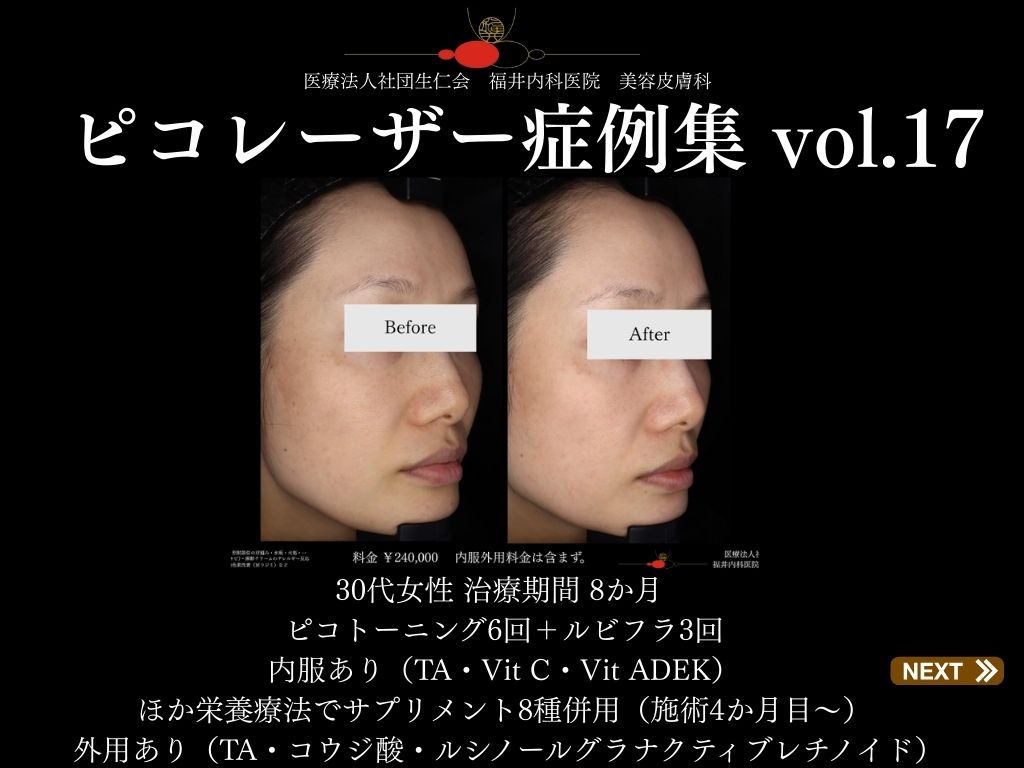 ピコレーザー症例_vol.17_001