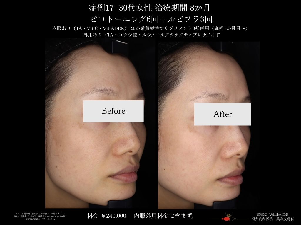 ピコレーザー症例_vol.17_002