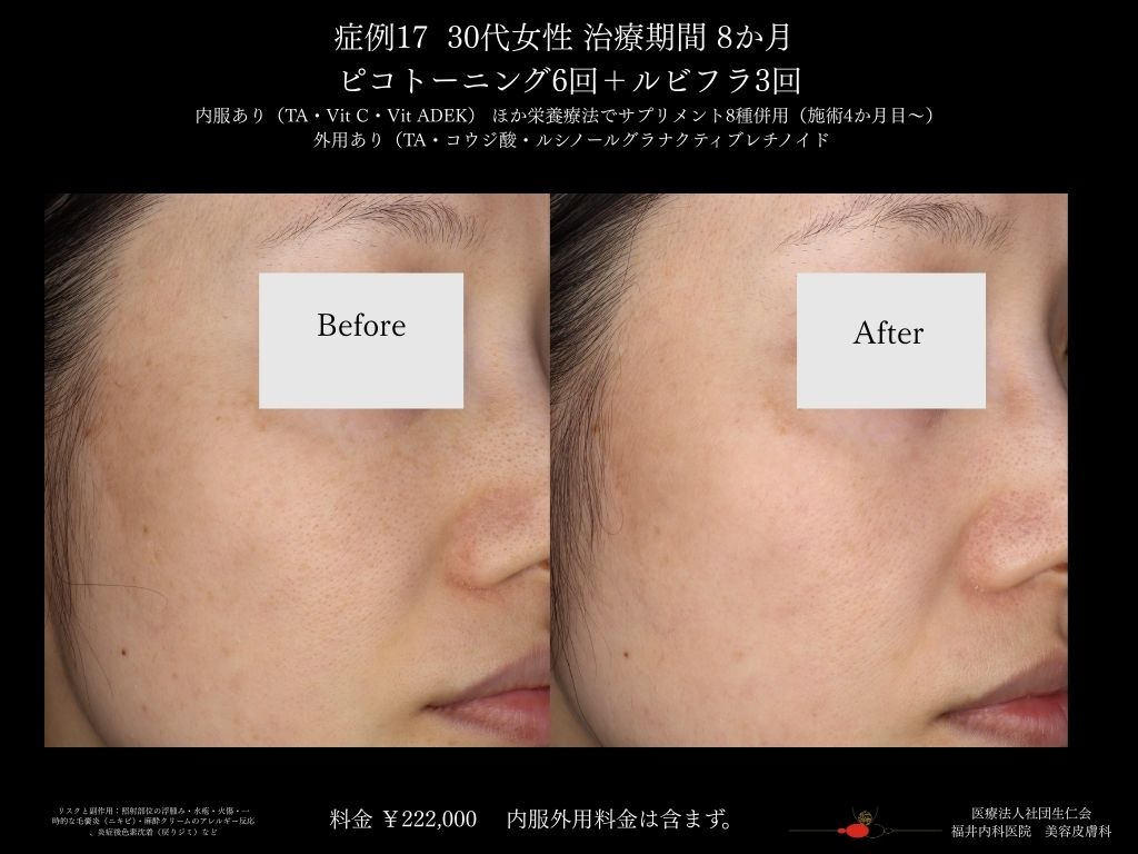 ピコレーザー症例_vol.17_003